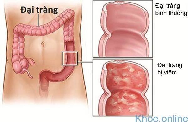 bệnh crohn