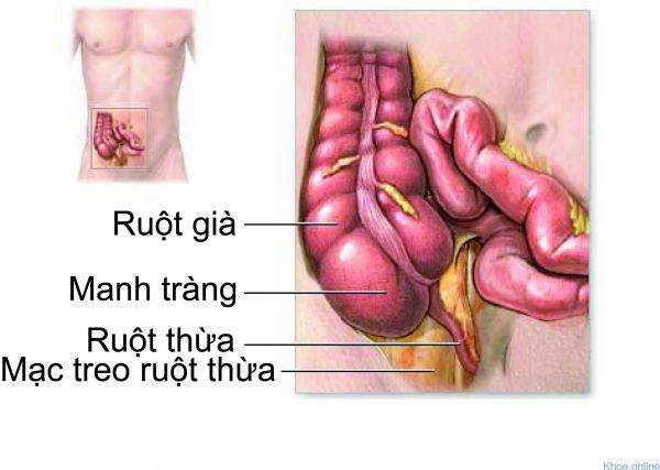 Viêm ruột thừa