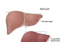 bệnh xơ gan cổ trướng