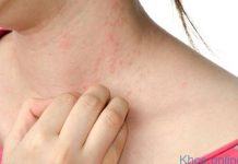 dị ứng là gì