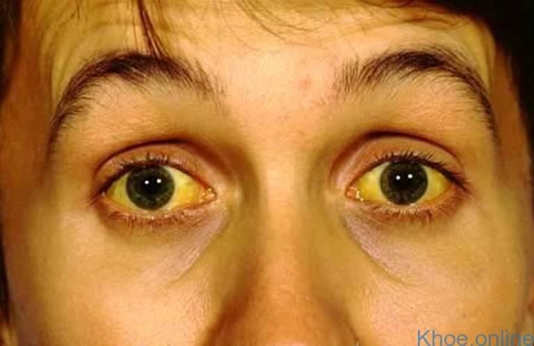 Mắt bị vàng là do có bệnh về gan