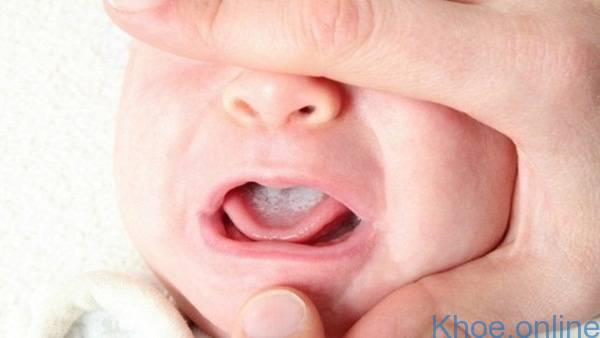 Tưa lưỡi ở trẻ sơ sinh