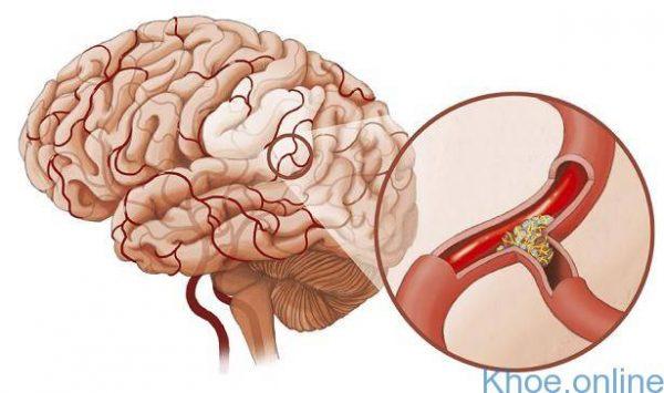 nhồi máu não