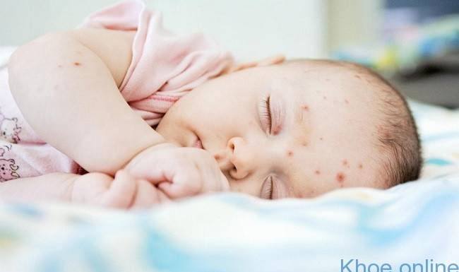 trẻ bị mụn nhọt trên đầu