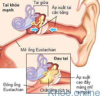 Viêm tai giữa cấp thủng màng nhĩ
