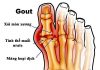 bệnh gout