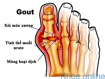 bệnh gout