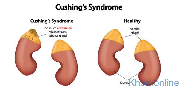 Hội chứng Cushing là do cơ thể tiếp xúc với quá nhiều hormone cortisol