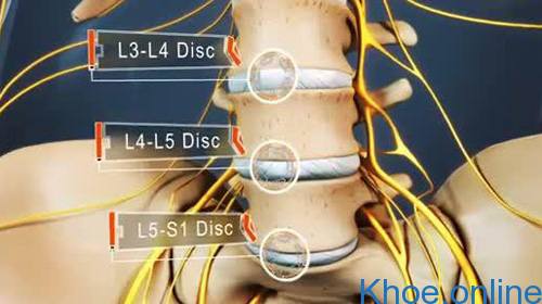 thoát vị đĩa đệm cột sống thắt lưng l5 s1 thoát vị đĩa đệm cột sống thắt lưng l5 s1