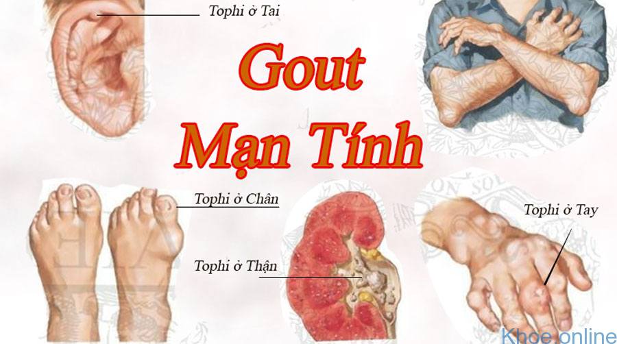 bệnh gout