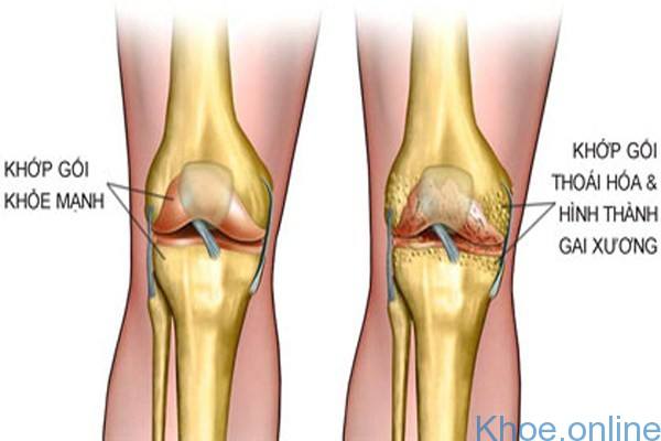 Viêm khớp gối xảy ra khi đầu gối phải chịu quá nhiều sức ép từ trọng lượng cơ thể Viêm khớp gối xảy ra khi đầu gối phải chịu quá nhiều sức ép từ trọng lượng cơ thể
