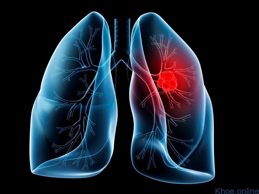 U trung biểu mô màng phổi - Một trong hai dạng của u trung biểu mô
