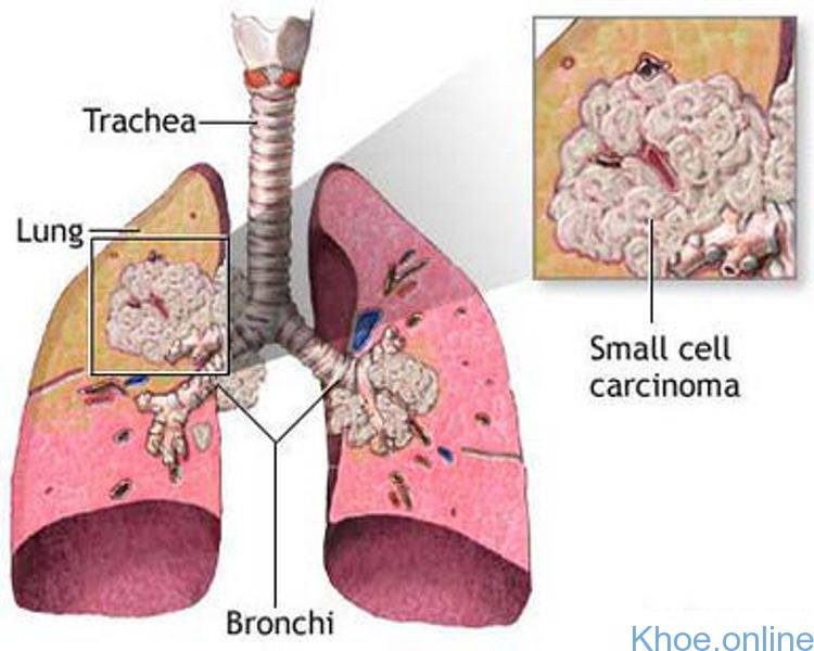Ung thư phổi tế bào nhỏ có tốc độ phát triển vô cùng nhanh chóng và lây lan sớm