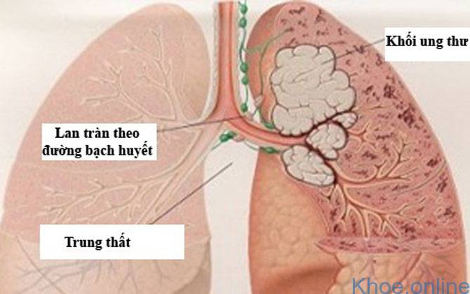 Ung thư phổi là do các tế bào trong mô phổi phát triển không kiểm soát được