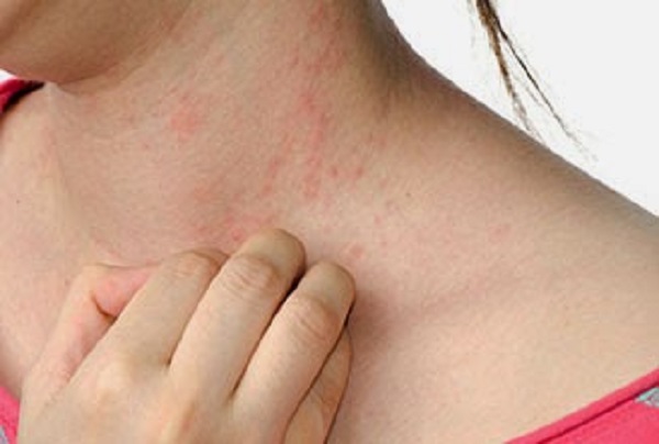 Nóng gan thường gây ra tình trạng ngứa kèm theo mẩn đỏ