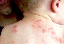 Phòng ngừa trong mùa dịch thủy đậu