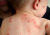 Bị giời leo bôi thuốc gì? Cách phòng ngừa bệnh giời leo hiệu quả