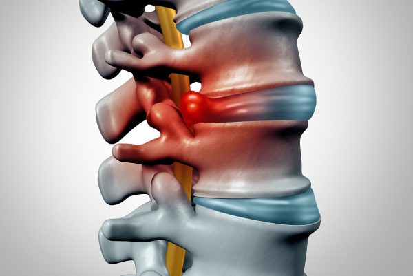 đĩa đệm thoát vị chèn ép dây thần kinh