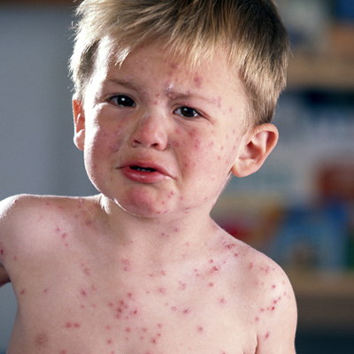 Nguyên nhân gây bệnh sởi ở trẻ em là một loại virus sởi thuộc họ Paramyxoviridae