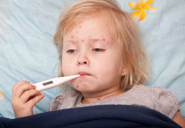 Bệnh sởi ở trẻ em – Tác nhân gây bệnh và những biến chứng nguy hiểm