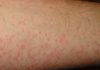 Nổi mẩn ngứa như muỗi đốt là dấu hiệu của bệnh gì?
