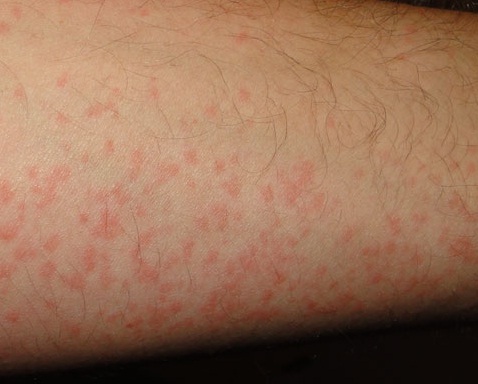 Nổi mẩn ngứa như muỗi đốt là dấu hiệu của bệnh gì?