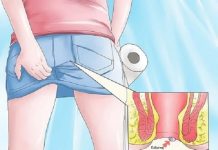 Mắc bệnh trĩ có nguy hiểm không?