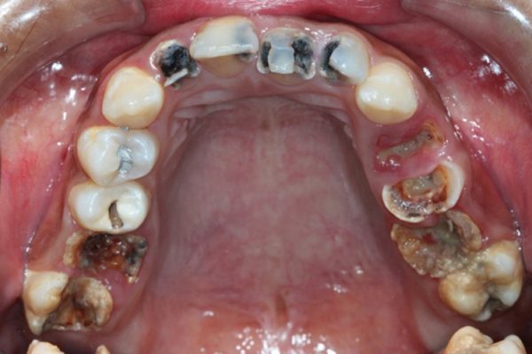 Bệnh răng miệng và mách bạn cách điều trị hiệu quả