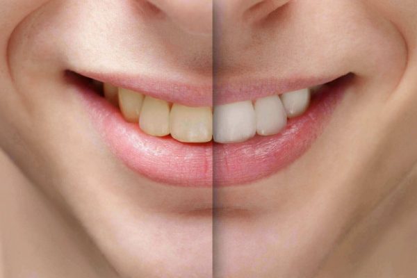Bệnh răng miệng và mách bạn cách điều trị hiệu quả