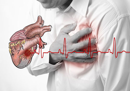 Ngừng tim đột ngột phải cấp cứu như thế nào?