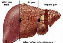 Phát hiện muộn, viêm gan C có thể tiến triền thành ung thư