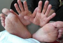 Bệnh tay chân miệng có nguy hiểm không?
