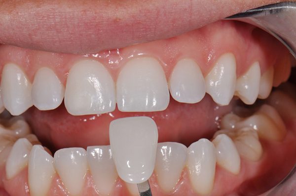 Bọc răng sứ thẩm mỹ có đau không?