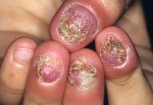Bệnh nấm móng tay có nguy hiểm không?