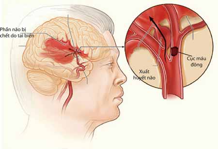 Nhận biết dấu hiệu xuất huyết não ở người già