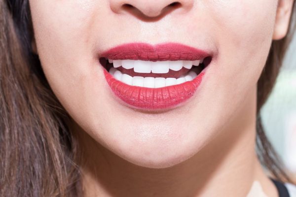 Nhiều người bệnh bị viêm lợi, tụt lợi, có kẽ chỉ đen ở chân răng sau khi làm răng sứ