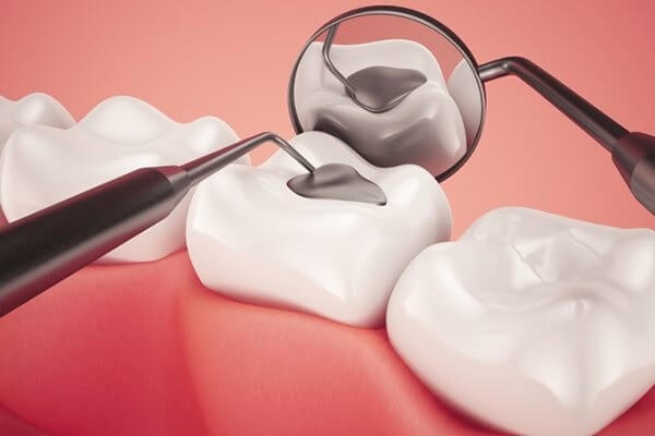 Trám răng hay hàn răn là một trong những giải pháp nha khoa thường được áp dụng để khôi phục những phần răng bị hư hỏng do sâu, mài mòn, nứt vỡ do bị lực tác động... Giúp chiếc răng trở lại hình dáng ban đầu và đảm bảo giữ được chức năng tương tự như răng tự nhiên, hỗ trợ khả năng nhai như cũ. Cùng tìm hiểu thêm về các loại trám răng hiện nay. Khi nào cần trám răng? Nếu răng gặp tình trạng bị hư hỏng do sâu răng, răng bị vụn, mòn qua sau thời gian dài hoặc do gặp phải chấn thương, tai nạn, bác sĩ nha khoa sẽ áp dụng hình thức trám răng để khôi phục lại nguyên hình dáng của chiếc răng.  Trám răng cũng được chia thành 2 hình thức là trám răng nhằm mục đích điều trị và trám răng để phòng ngừa.  Nếu răng bị khiếm khuyết hay đã bị sâu, trám răng giúp hồi phục lại hình dáng của răng cũng như hạn chế nguy cơ sâu răng nghiêm trọng hơn. Ngoài ra bác sĩ nha khoa cũng cần kiểm tra lại tình trạng của răng để đưa ra chuẩn đoán là nên trám hay nhổ, đảm bảo không gây tổn thương sâu trong chân răng về sau. Trong khi đó hình thức trám răng để phòng sâu răng được thực hiện bằng cách phủ lớp vật liệu bảo vệ quanh răng, có màu sắc giống men răng để ngăn chặn sự xâm nhập của vi khuẩn. Đồng thời điều này cũng giúp hạn quá trình lên men tạo axit có thể gây phá hủy men răng lâu dài. Chất liệu và các loại trám răng Trên thị trường hiện nay cung cấp rất nhiều chất liệu trám răng khác nhau dựa trên thành phần nguyên liệu, khả năng sử dụng, tính thẩm mỹ và giá thành.  Thông thường các loại vật liệu trám phổ biến là: Amalgam, silicat, composite... Trong đó chất liệu amalgam và silicat có giá thành rẻ, độ bền cao nhưng dễ gây kị ứng khi ăn phải đồ quá nóng hoặc lạnh. Chất liệu composite được ưa chuộng hơn dù giá thành khá cao bởi tính thẩm mỹ tốt, màu sắc tương đồng với men răng nhưng độ bền, thời gian duy trì không cao bằng. Các loại trám răng phổ biến hiện nay gồm có: -Trám răng vàng: sử dụng chất liệu ánh vàng đề bọc răng, thời gian sử dụng loại trám này khá cao lên đến 20 năm, chi phí cũng khá tốn kém nhưng mặt thẩm mỹ không được tốt. -Trám răng hỗn hợp (dùng chất liệu amalgam): khả năng chịu mài mòn và chịu lực tốt, không gây kích ứng và giá cả phải chăng nhưng tính thẩm mỹ không cao, màu sắc vùng trám tối màu hơn vùng răng tự nhiên, chỉ phù hợp cho những vị trí răng ở bên trong. -Trám răng plastic tổng hợp composite: chất liệu tương đồng với màu sắc của răng nên có tính thẩm mỹ cao, khá dễ mòn và bong bật nên chỉ phù hợp cho những lỗ trám nhỏ, tuổi thọ thấp hơn các loại vật liệu khác. -Trám răng sứ thẩm mỹ: là loại trám răng được ưa chuộng nhất bởi chất liệu sứ cả khả năng làm đầy hiệu quả, thời gian duy trì lâu dài, màu sắc vùng trám tự nhiên nhưng có mức giá khá cao. Quy trình trám răng Trước khi thực hiện trám, răng sẽ được tiến hành loại bỏ chất dư thừa, cặn bám và chất làm sâu răng, thực hiện thao tác mài mòn răng để đắp nguyên liệu trám cho vừa vặn hơn.  Cụ thể: -Làm sạch vùng răng và tiến hành gây tê cục bộ nơi trám để đảm bảo quá trình làm không đau nhức. -Loại bỏ phần răng bị sâu, đã bị phần rã do axit mài mòn. -Chọn lựa chất liệu trám răng theo nhu cầu người được trám răng và dựa theo tình hình của răng.  -Cách ly vùng răng cần trám khỏi môi, nướu, khoang miệng bởi đế cao su trước khi thực hiện trám. -Chuẩn bị vùng trám bằng cách dùng axit photphoric loại 30% đổ lên vùng trám và chờ khoảng 15s, sục lại với nước, răng và lớp men được làm khô sẽ để lại lớp mờ để chuẩn bị trám. -Bôi chất kết dính lên phần trám. -Đổ đầy chất liệu trám vào khoang trám, khi chất liệu dần dẻo lại nha sĩ sẽ tiến hành tạo hình. Sau khi cứng lại sẽ được định hình bằng dụng cụ cắt và mùi sao cho vừa khớp với răng. -Sau khi thay chất liệu trám, đế cao su được gỡ ra và bệnh nhân được kiểm tra lại khớp cắn, đảm bảo không có độ chênh. -Hoàn thiện lại phần trám và đánh bóng lại bề mặt răng. Lưu ý chăm sóc răng sau khi trám -Hạn chế ăn, nhai đồ cứng hoặc quá nóng, quá lạnh tại vị trí đã trám. -Hạn chế các tác động va đập gây tổn thương đến răng đã trám. -Không nên thường xuyên uống những chất có màu như cà phê, trà, nước ngọt có gas, hút thuốc lá... bởi dễ gây xỉn màu và hỏng men răng. -Vệ sinh răng miệng thường xuyên và đúng cách, đặc biệt là những vùng đã bị trám. -Thực hiện khám răng định kỳ 3-6 tháng để kiểm tra chất lượng vùng răng đã trám và toàn bộ răng. Trám răng là một trong giải pháp thẩm mỹ hiệu quả và an toàn, đã được nhiều người áp dụng. Tuy vậy nên thường xuyên kiểm tra và hạn chế nguy cơ sâu răng, để hạn chế nguy cơ răng bị hư hỏng nghiêm trọng về sau.