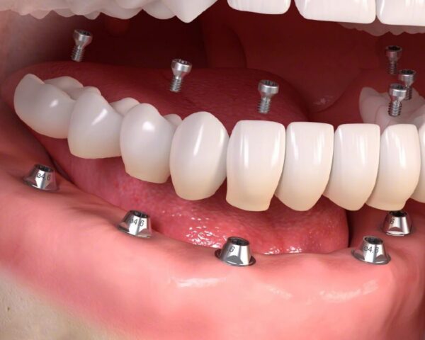 Trồng răng giả bằng cách cấy ghép Implant