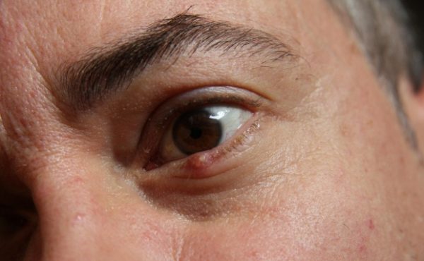 Mách bạn cách phân biệt chắp mắt và lẹo mắt