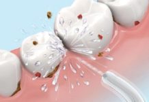 cạo vôi răng có đau không không còn là nỗi lo khi đã có công nghệ mới