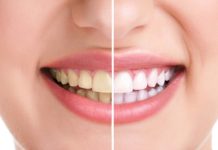 Răng ố vàng là bệnh gì? Nguyên nhân và cách khắc phục