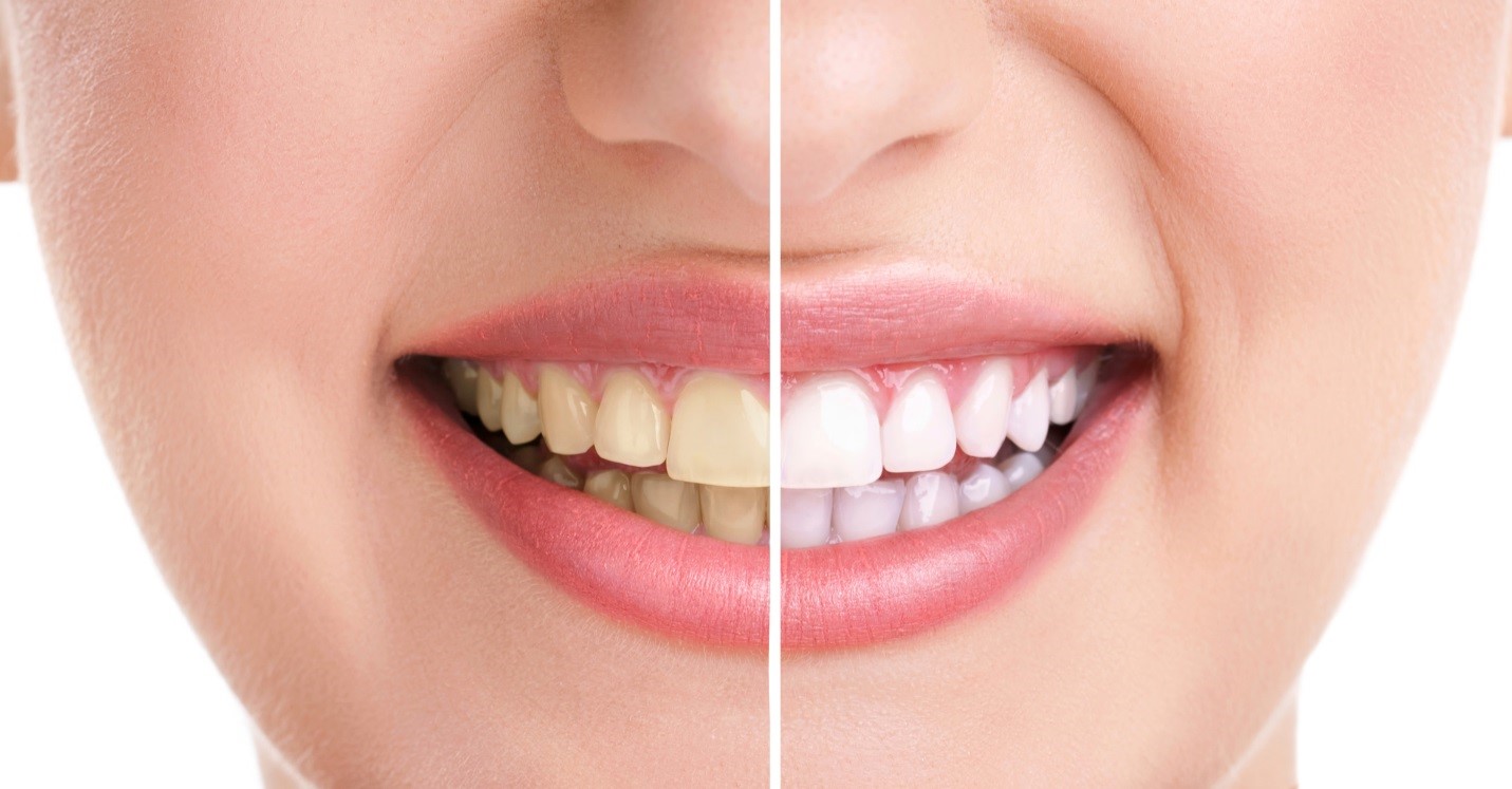 Răng ố vàng là bệnh gì? Nguyên nhân và cách khắc phục