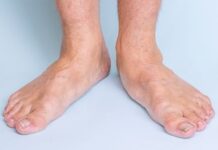 hội chứng bàn chân bẹt có nguy hiểm không