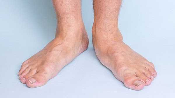 hội chứng bàn chân bẹt có nguy hiểm không