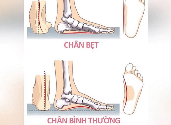 xác định hội chứng bàn chân bẹt
