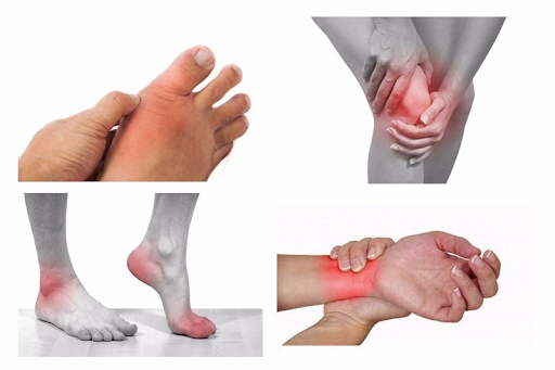 Viêm khớp xảy ra ở một nhiều vị trí như khớp ở bàn chân, đầu gối, cổ chân và cổ tay
