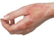 thuốc trị sẹo bỏng