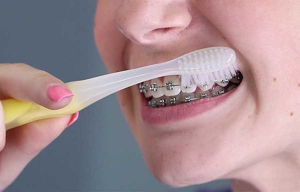 chăm sóc răng miệng cho trẻ khi niềng răng