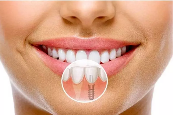 Hướng dẫn chăm sóc răng sau khi trồng Implant toàn hàm