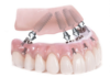 Phương pháp trồng răng Implant toàn hàm: All on 4